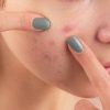 Homemade Remedies for Acne Pimples