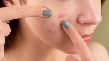 Homemade Remedies for Acne Pimples